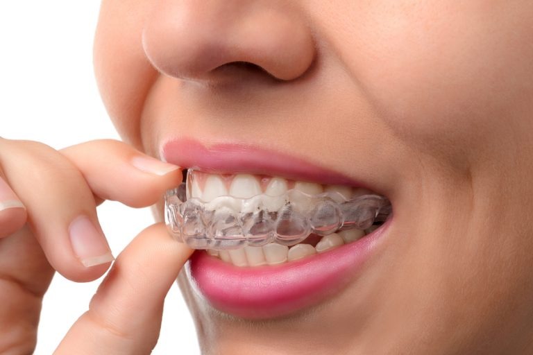 Invisalign in Arlington: Advanced Attachments That Solve Severe Bite Misalignments